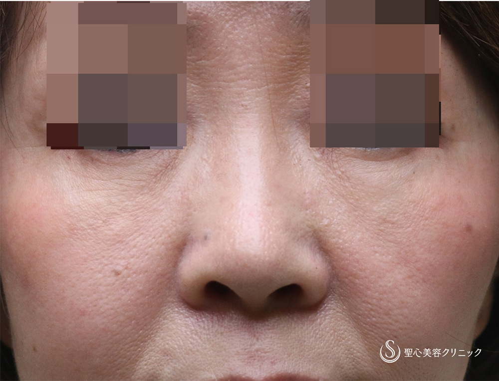 【50代女性・目の下のたるみ】プレミアムPRP皮膚再生療法長期経過（施術後3年） After 