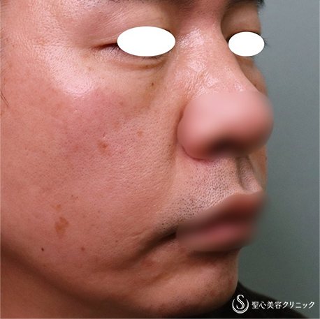 【40代男性・目の下＆ほうれい線】プレミアムPRP皮膚再生療法（8ヶ月後） Before 