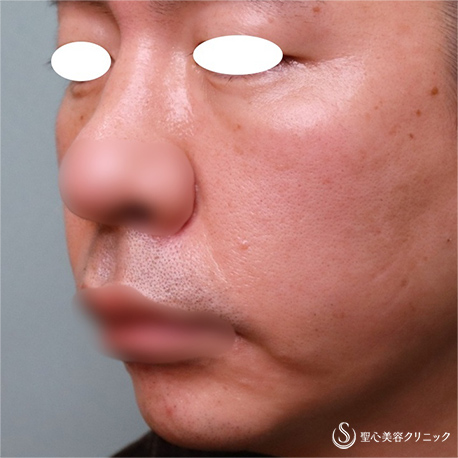 【40代男性・目の下＆ほうれい線】プレミアムPRP皮膚再生療法（8ヶ月後） Before 