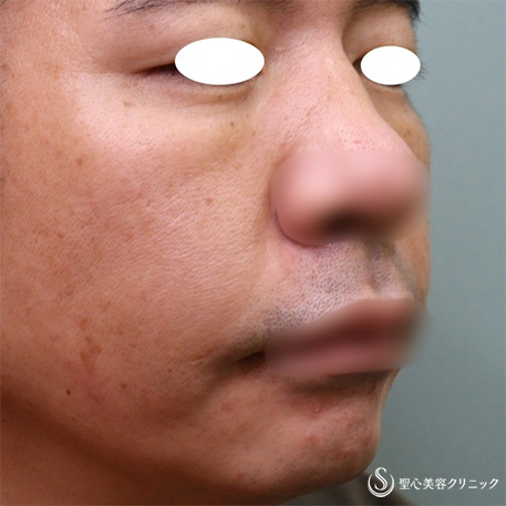 【40代男性・目の下＆ほうれい線】プレミアムPRP皮膚再生療法（8ヶ月後） After 