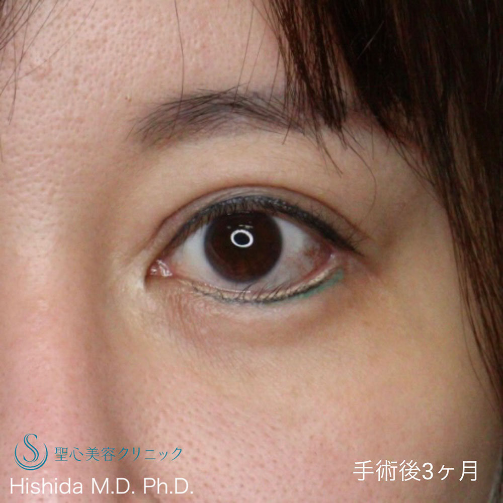 【40代女性・目を大きくたれ目の印象にしたい】眼瞼下垂（切開法/腱膜縫縮法）＋たれ目形成（グラマラスライン形成／下眼瞼下制術）（3ヶ月後） After 