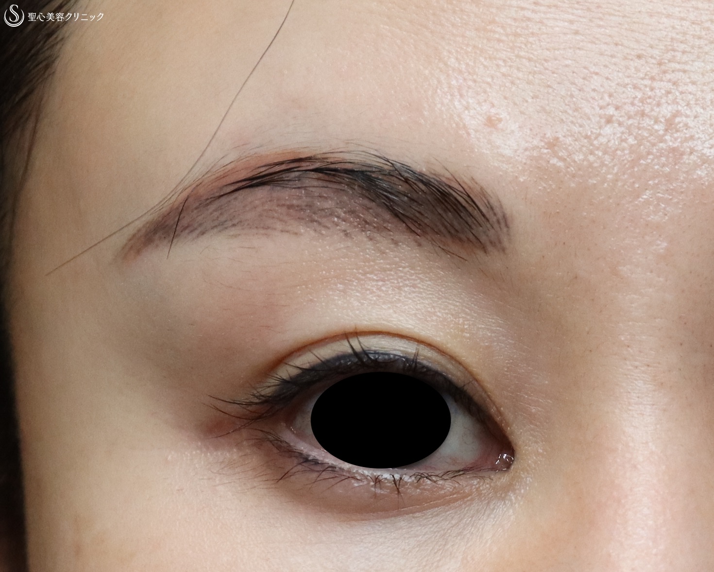 【30代女性・目の上の窪みが劇的に改善】プレミアムPRP皮膚再生療法（4ヶ月後） After 