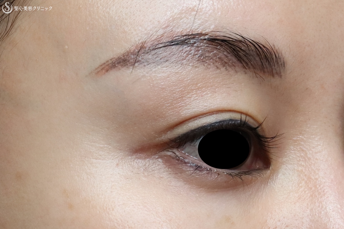 【30代女性・目の上の窪みが劇的に改善】プレミアムPRP皮膚再生療法（4ヶ月後） After 