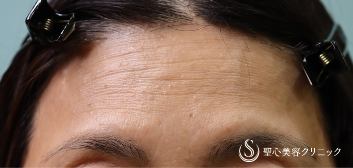 【60代女性・額のしわ】プレミアムPRP皮膚再生療法（3カ月後） Before 