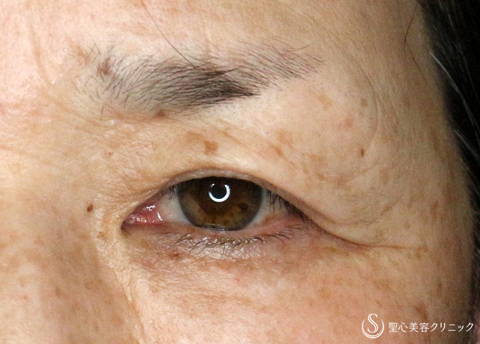 【60代女性・整形ではなく10年前の目元に戻す】眉下リフト単独（2年4ヶ月後） Before 