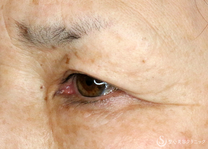 【60代女性・整形ではなく10年前の目元に戻す】眉下リフト単独（2年4ヶ月後） Before 
