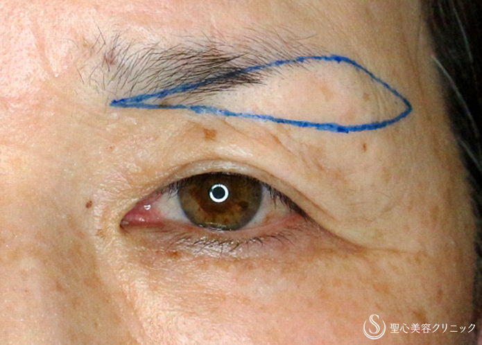 【60代女性・整形ではなく10年前の目元に戻す】眉下リフト単独（2年4ヶ月後） Before 