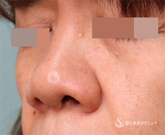 【50代女性・鼻のボリューム】小鼻縮小術（4か月後） Before 