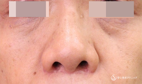 【50代女性・鼻のボリューム】小鼻縮小術（4か月後） After 
