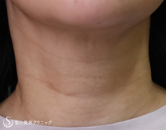 【40代女性・首の横皺】プレミアムPRP皮膚再生療法（3ヶ月後） Before 