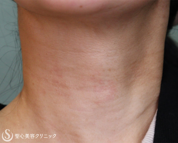 【40代女性・首の横皺】プレミアムPRP皮膚再生療法（3ヶ月後） After 