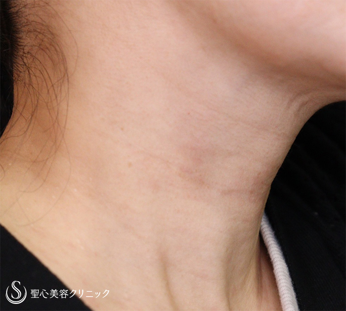 【40代女性・首の横皺】プレミアムPRP皮膚再生療法（3ヶ月後） After 