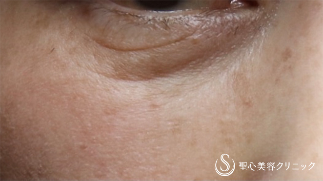 【50代女性・目の下のクマ,ほうれい線】プレミアムPRP皮膚再生療法（2年後） Before 