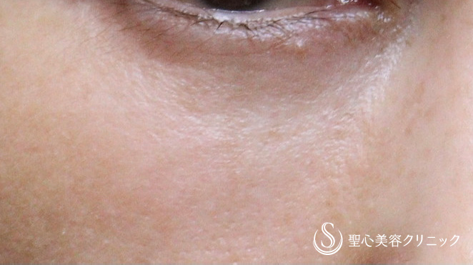 【50代女性・目の下のクマ,ほうれい線】プレミアムPRP皮膚再生療法（2年後） After 