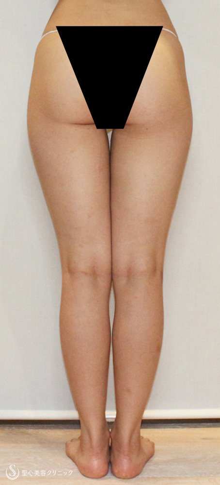 【20代女性・元々美脚をさらに細く美しく】リポセルモニター（1ヶ月後） Before 
