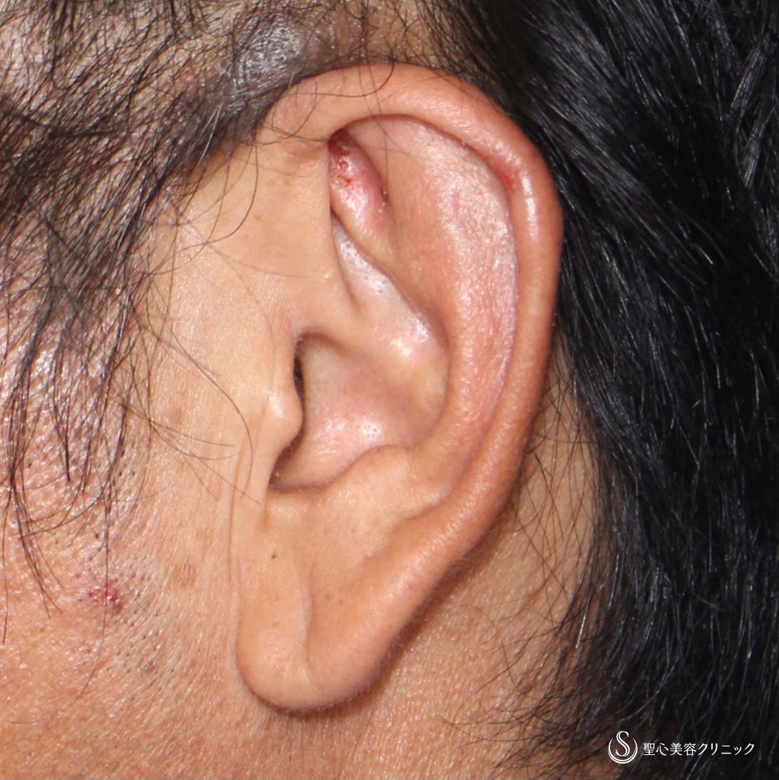 【40代男性・立ち耳を改善！！】立ち耳修正（埋没法）（術後2週間） Before 