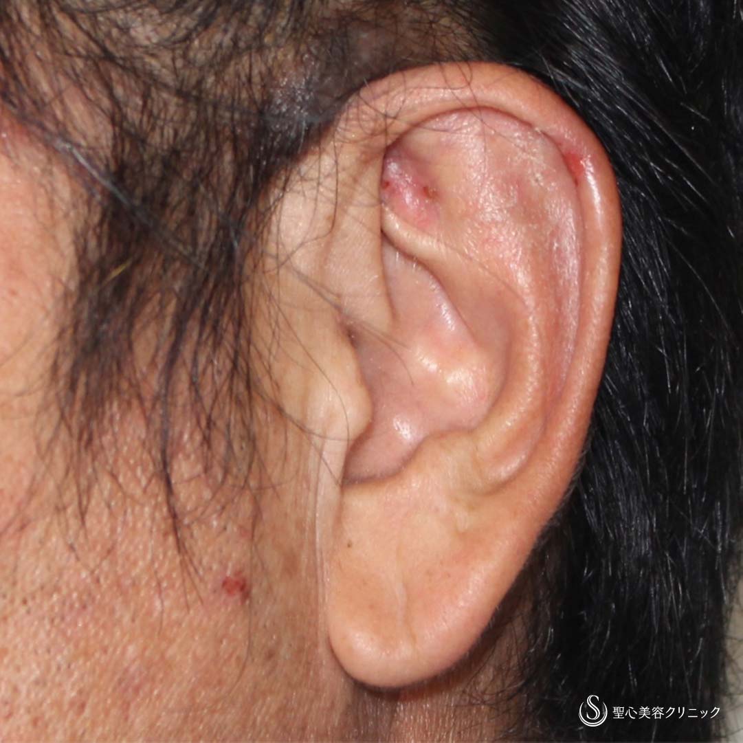 【40代男性・立ち耳を改善！！】立ち耳修正（埋没法）（術後2週間） Before 