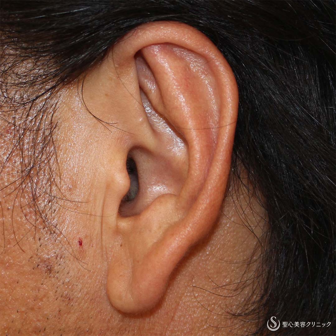 【40代男性・立ち耳を改善！！】立ち耳修正（埋没法）（術後2週間） After 