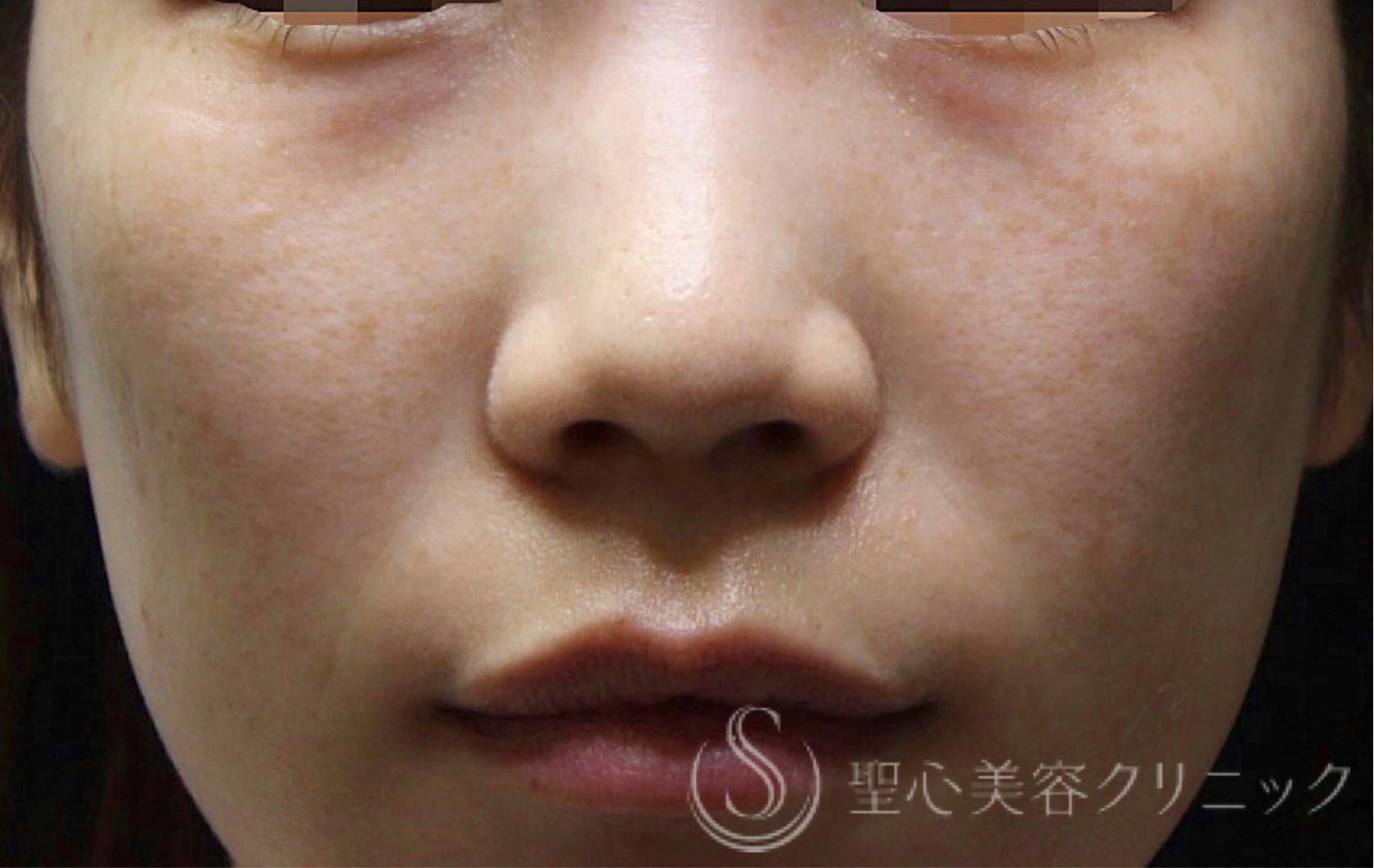 【20代女性・切らない目の下の若返り治療】プレミアムPRP皮膚再生療法（3ヶ月後） Before 