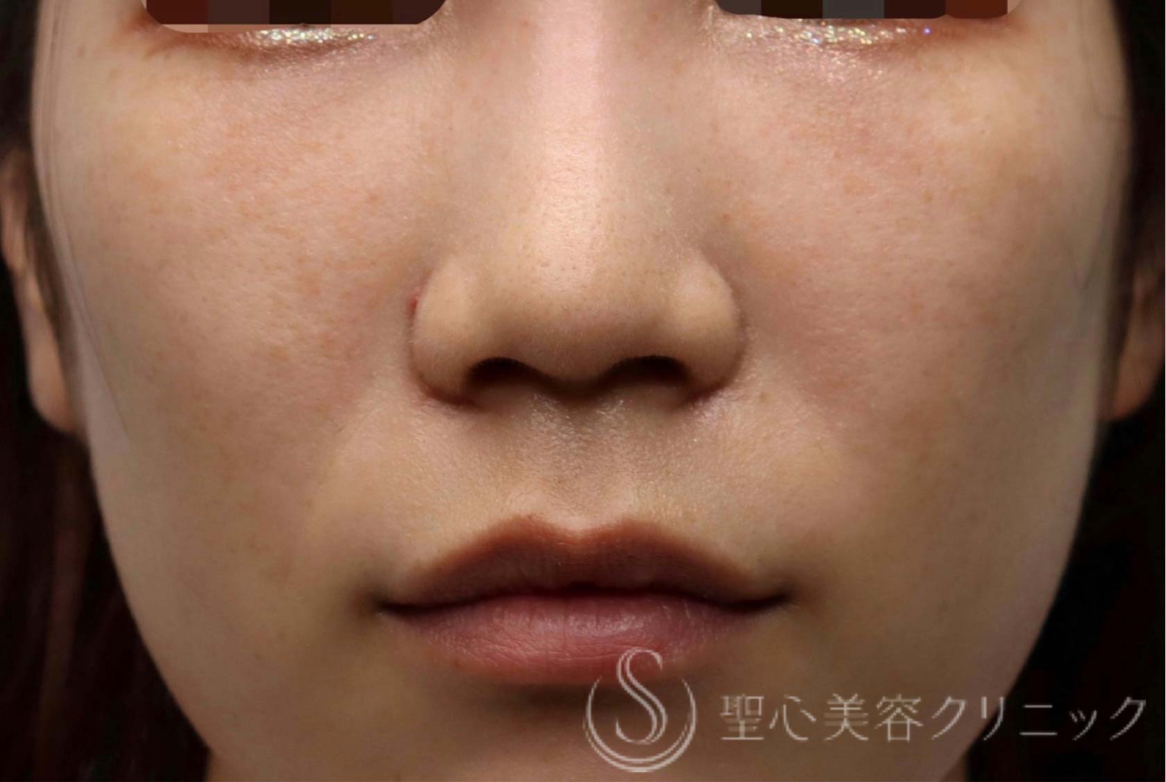 【20代女性・切らない目の下の若返り治療】プレミアムPRP皮膚再生療法（3ヶ月後） After 