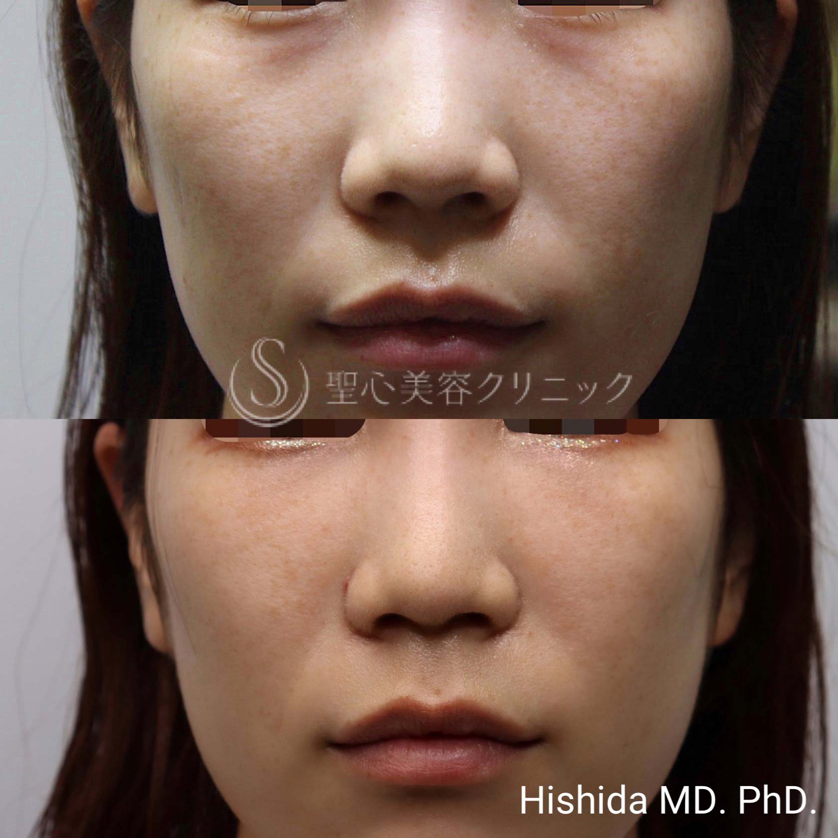 【20代女性・切らない目の下の若返り治療】プレミアムPRP皮膚再生療法（3ヶ月後） After 