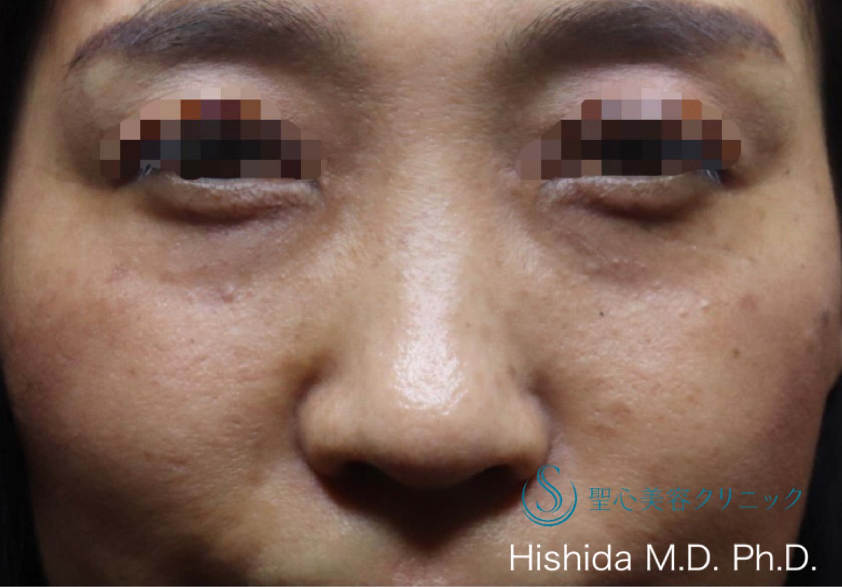 【50代女性・切らない目の下の若返り治療】プレミアムPRP皮膚再生療法（7ヶ月後） Before 