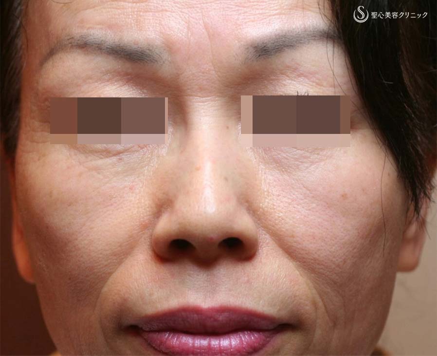 【60代女性・ほうれい線、目の下、眉間のしわ】プレミアムPRP皮膚再生療法（術後12年） Before 