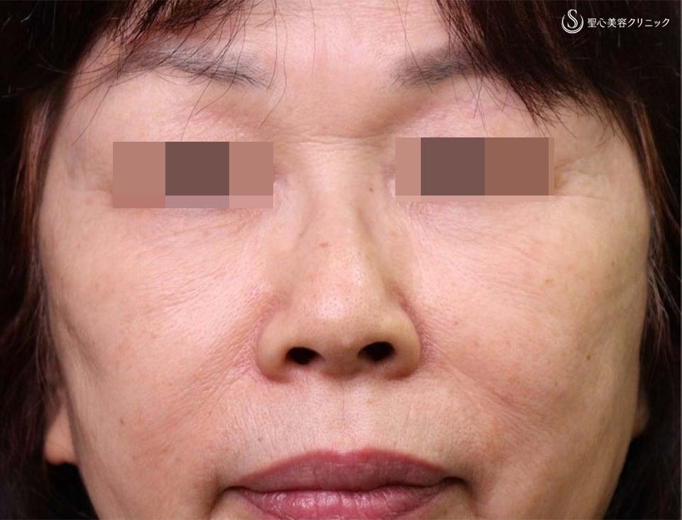 【60代女性・ほうれい線、目の下、眉間のしわ】プレミアムPRP皮膚再生療法（術後12年） After 