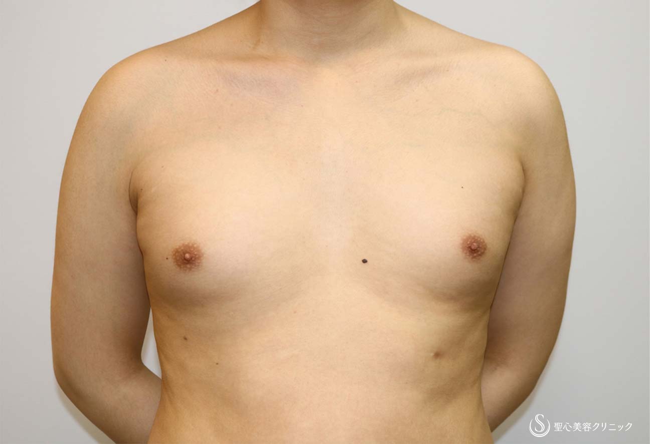 【男性・偽性女性化乳房】脂肪吸引（胸） Before 