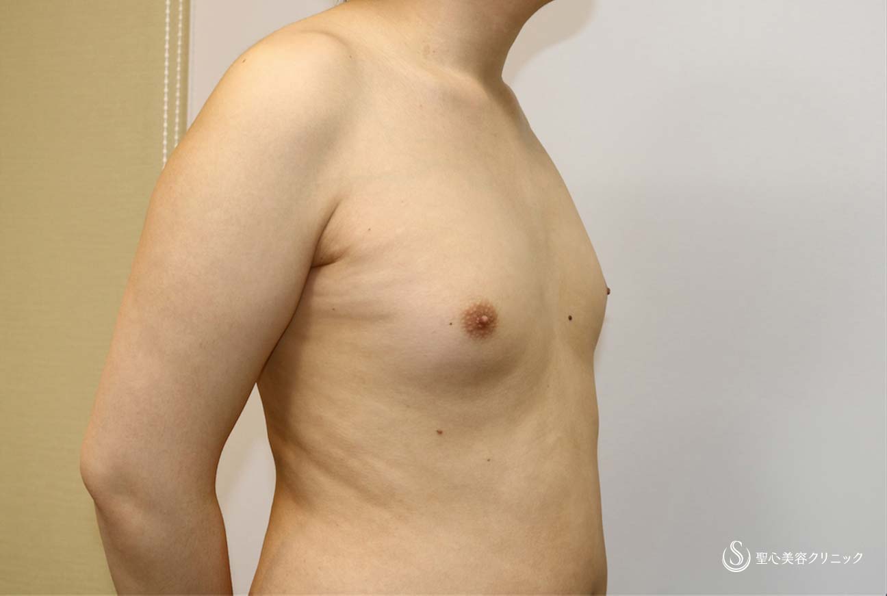 【男性・偽性女性化乳房】脂肪吸引（胸） Before 