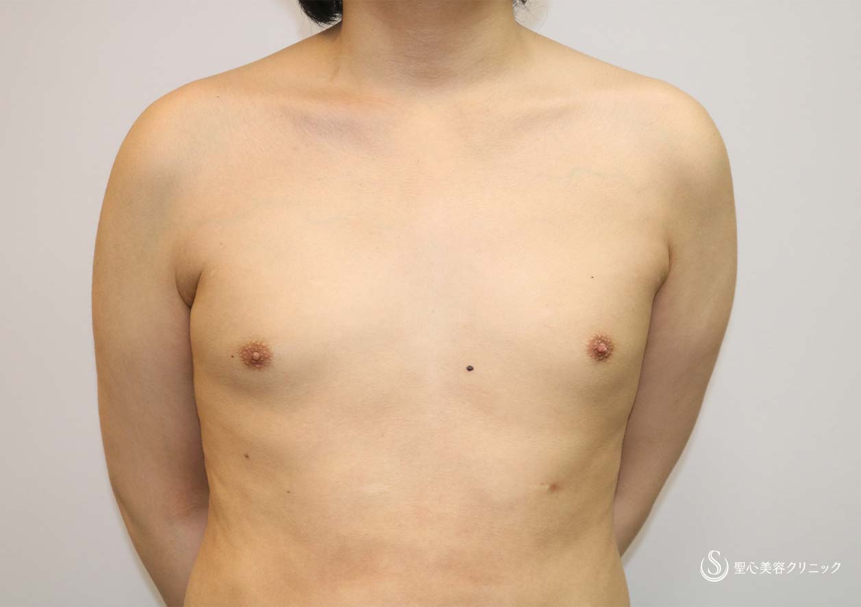 【男性・偽性女性化乳房】脂肪吸引（胸） After 