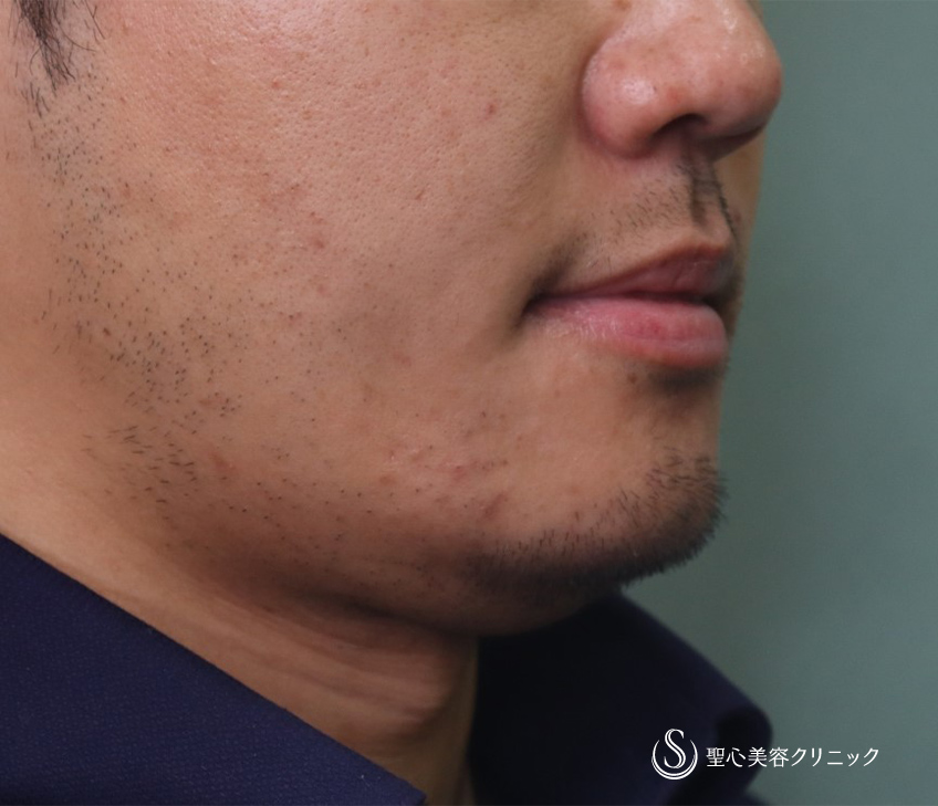 【30代男性・あご下のボリューム】FatX脂肪溶解注射（3回施術後） Before 