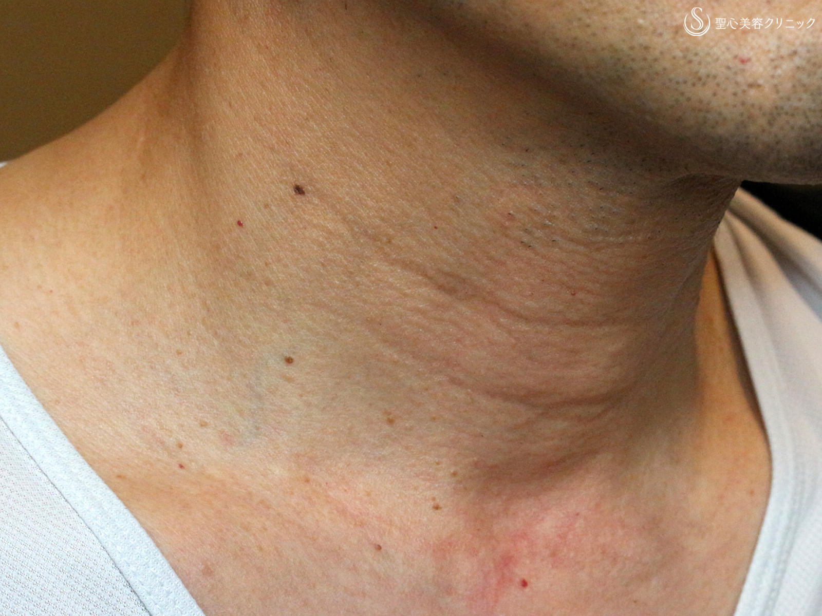 【50代男性・首の横じわは難しい】プレミアムPRP皮膚再生療法 単独（4年7ヶ月後） Before 