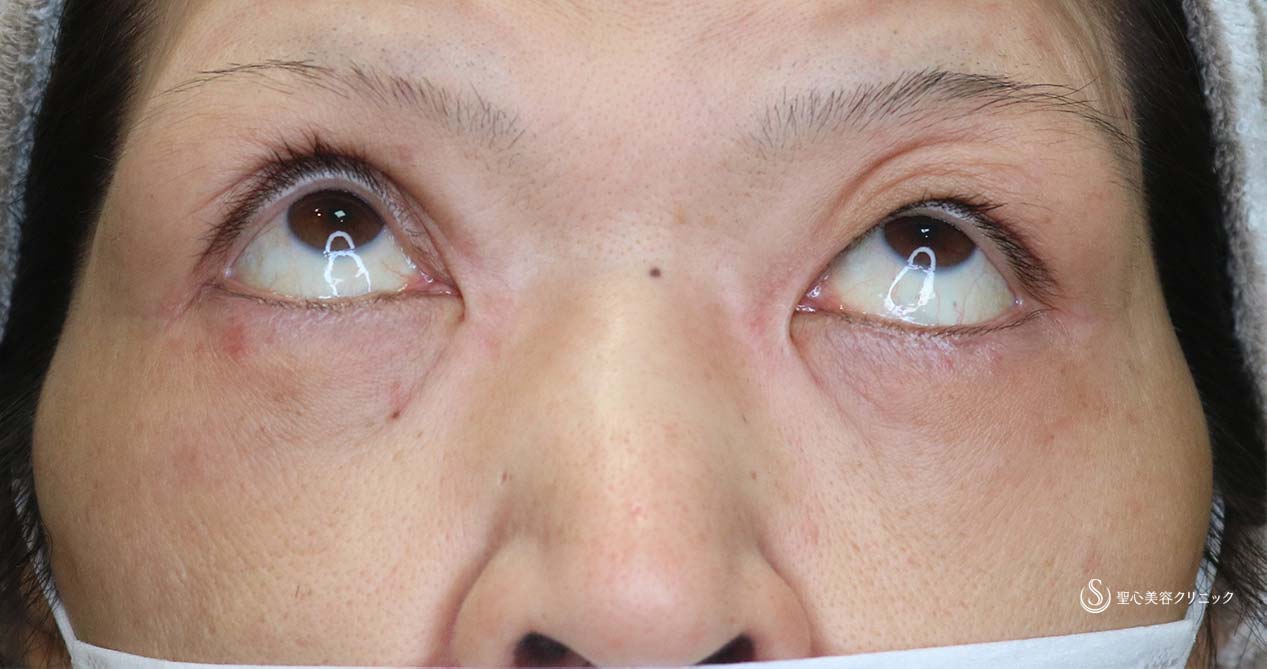 【女性・他院修正】眼瞼下垂（切開法/腱膜縫縮法）（術後2か月） Before 