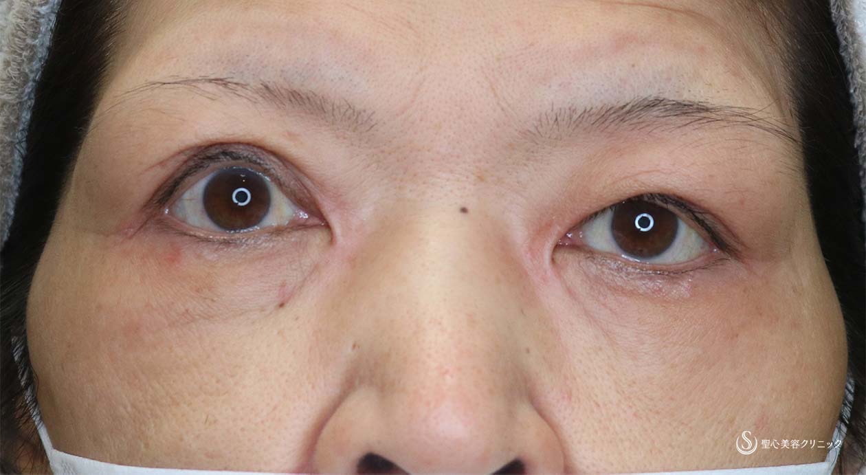 【女性・他院修正】眼瞼下垂（切開法/腱膜縫縮法）（術後2か月） Before 