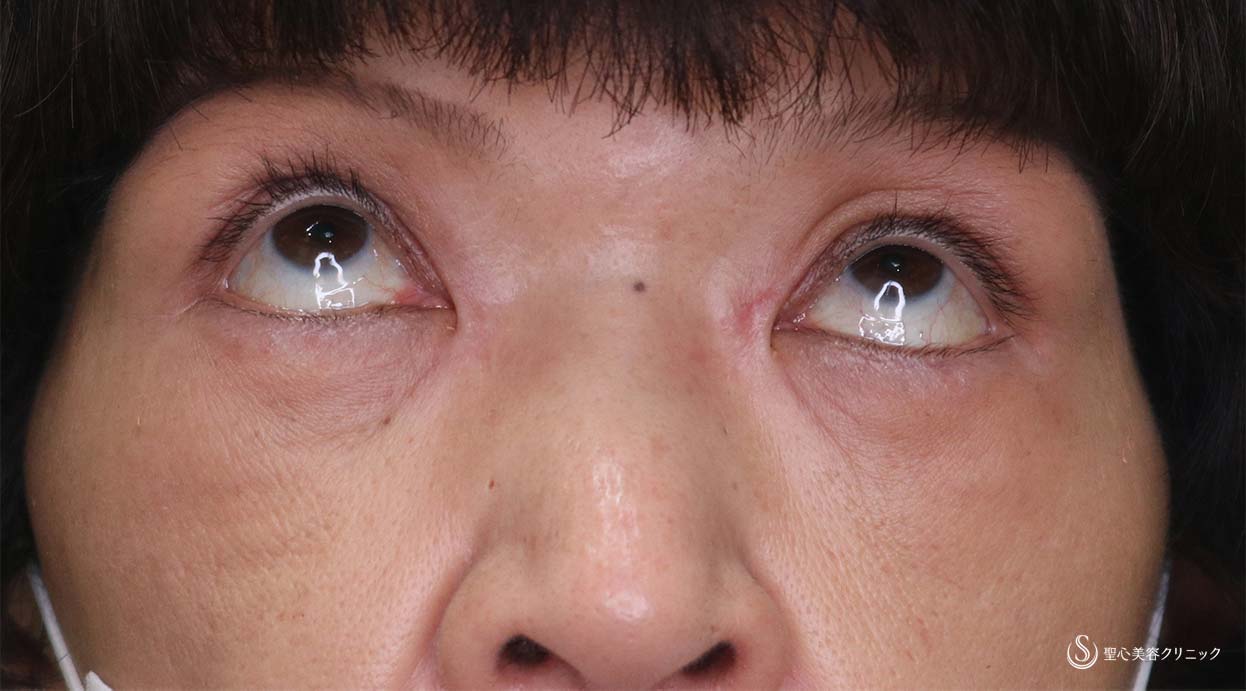 【女性・他院修正】眼瞼下垂（切開法/腱膜縫縮法）（術後2か月） After 