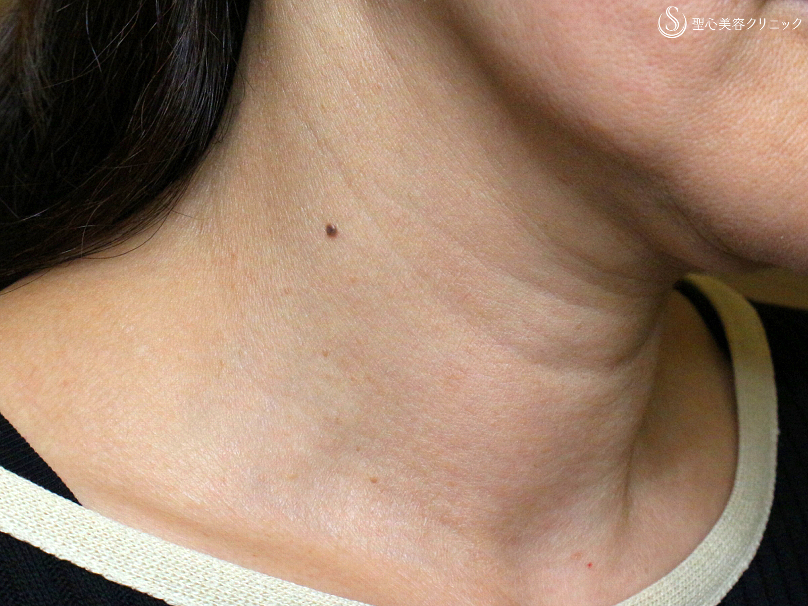 【50代女性・年齢を隠せない首の横ジワ】プレミアムPRP皮膚再生療法 （4ヶ月後） Before 