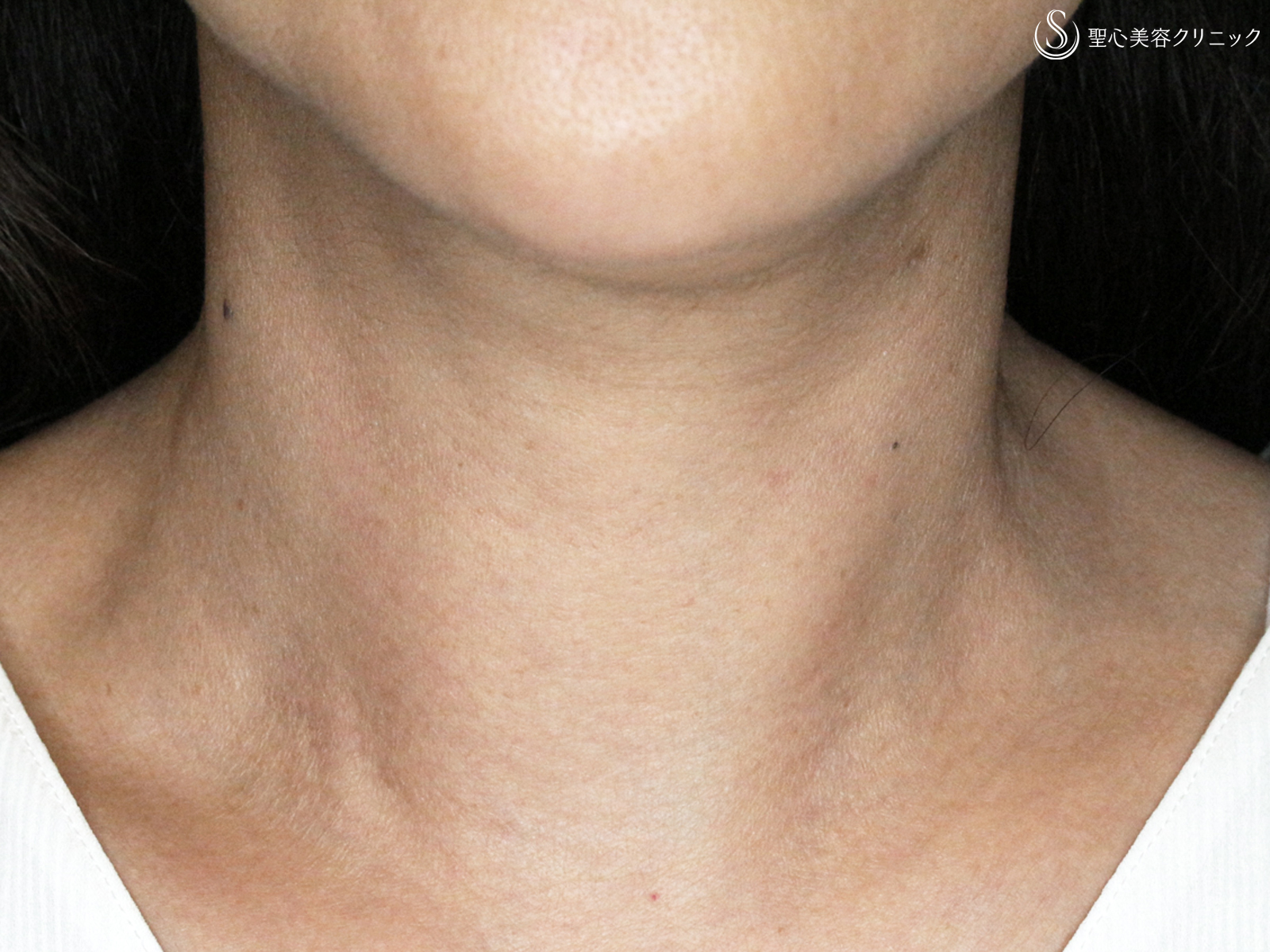 【50代女性・年齢を隠せない首の横ジワ】プレミアムPRP皮膚再生療法 （4ヶ月後） After 