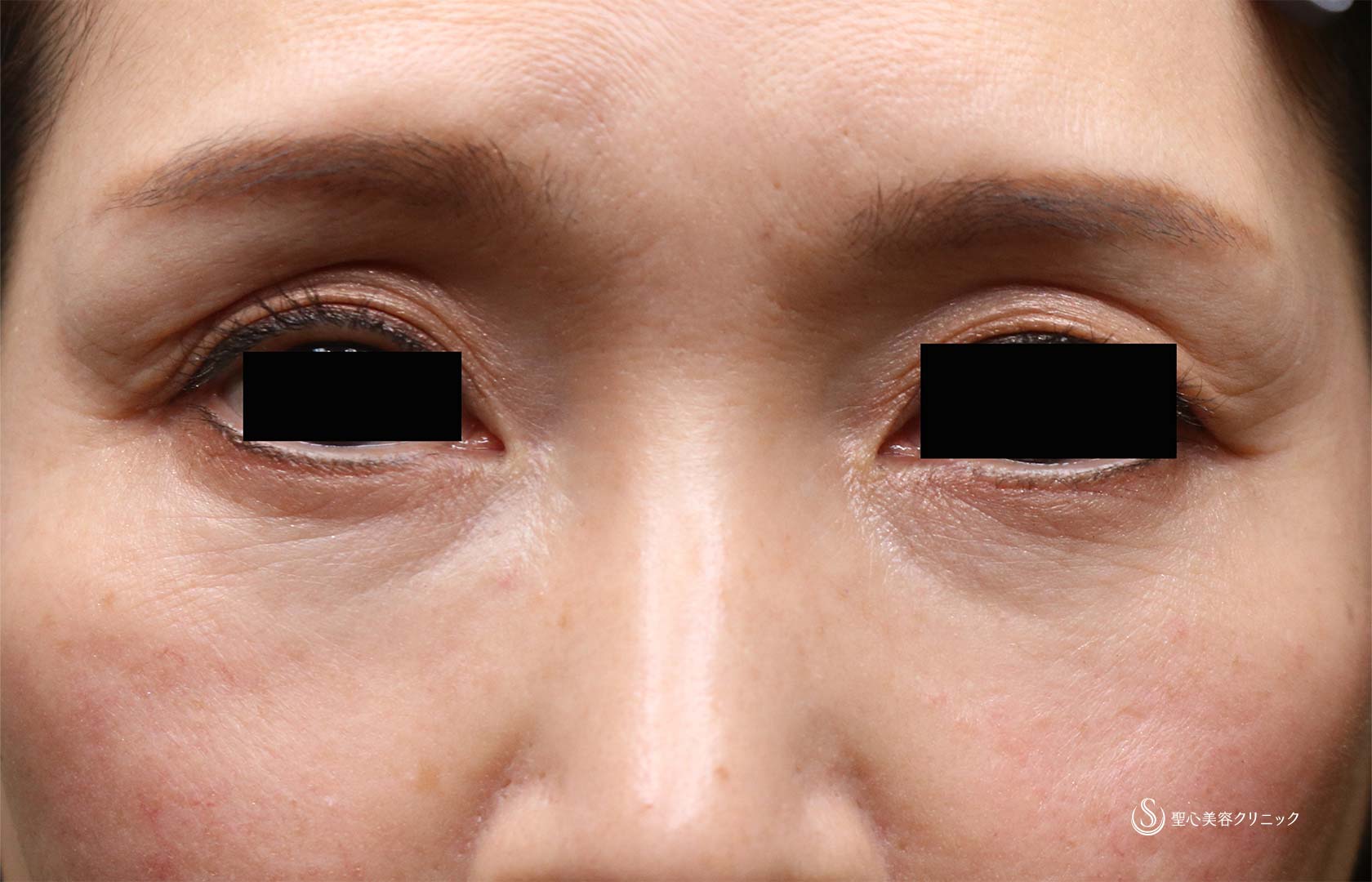 【50代女性・目の上、目の下】プレミアムPRP皮膚再生療法（1年後） Before 