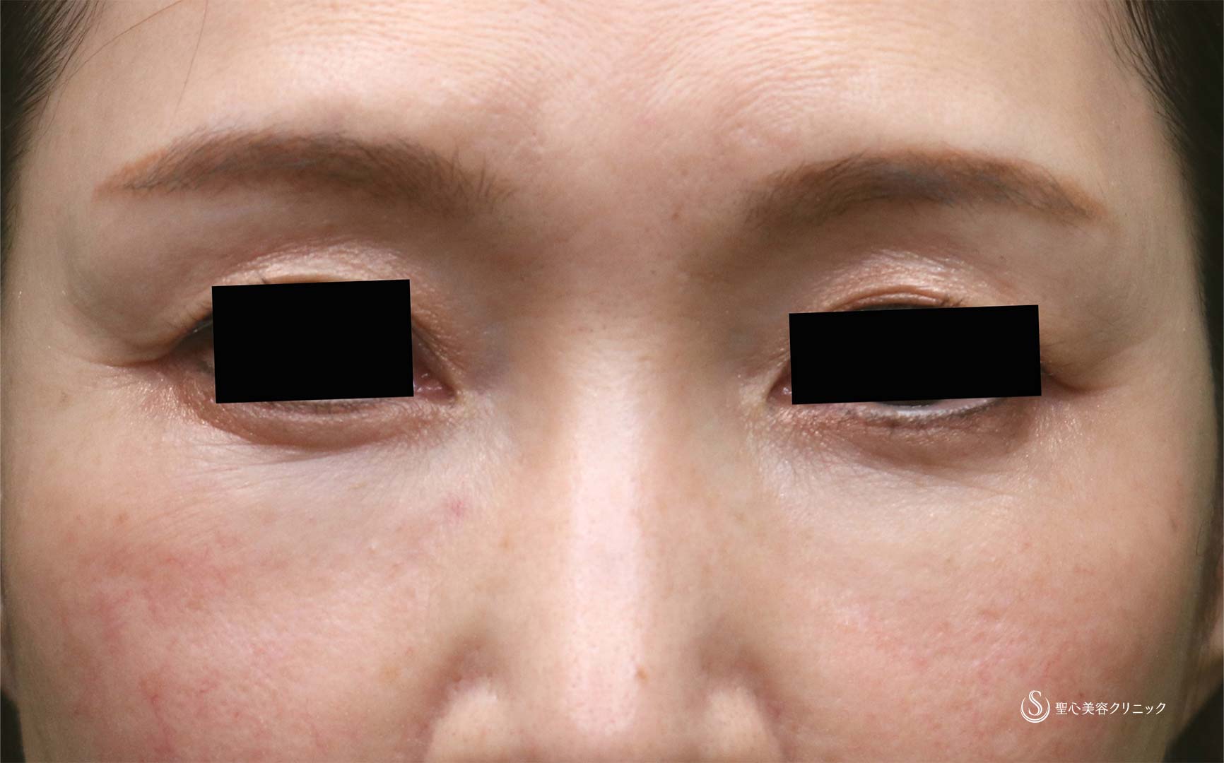 【50代女性・目の上、目の下】プレミアムPRP皮膚再生療法（1年後） After 