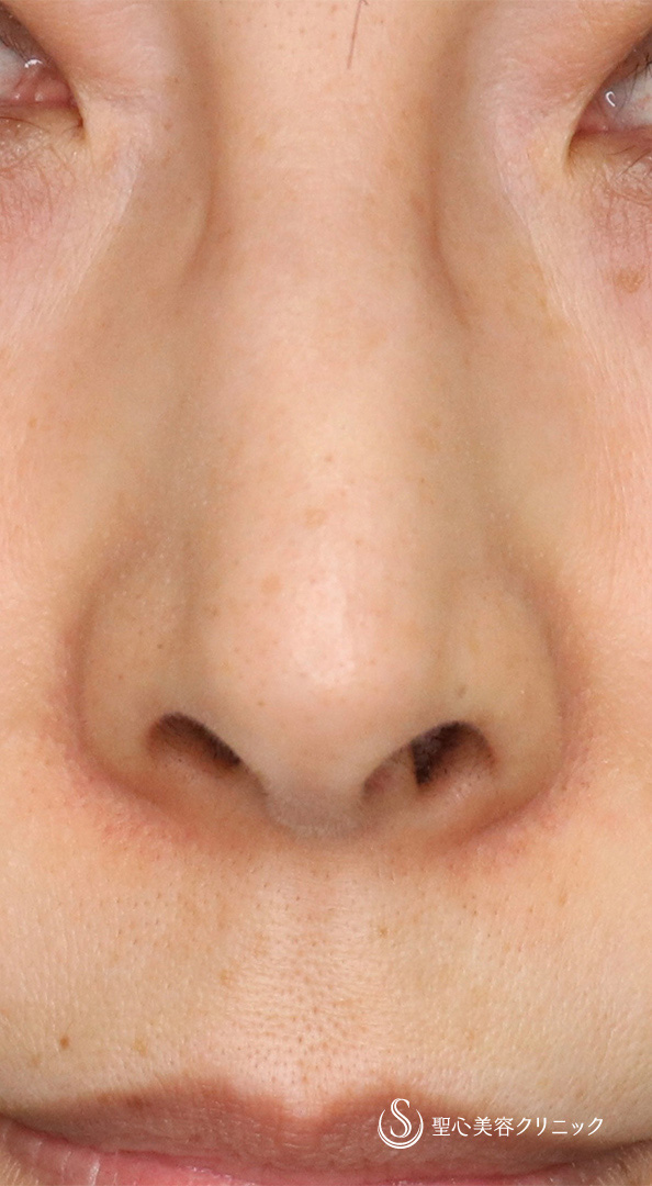 【50代女性・鼻の穴を目立ちにくく！！】鼻孔縁下降術（術後2週間） Before 