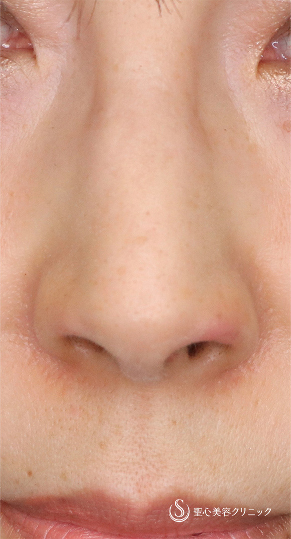 【50代女性・鼻の穴を目立ちにくく！！】鼻孔縁下降術（術後2週間） After 