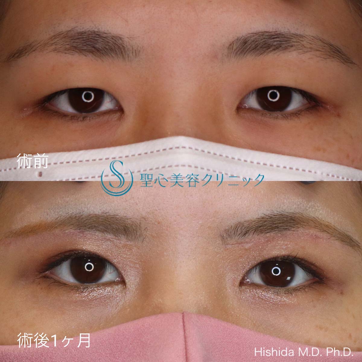 【20代女性・目の上をスッキリと！！】眉下リフト（眉下切開法）（1ヶ月後） After 