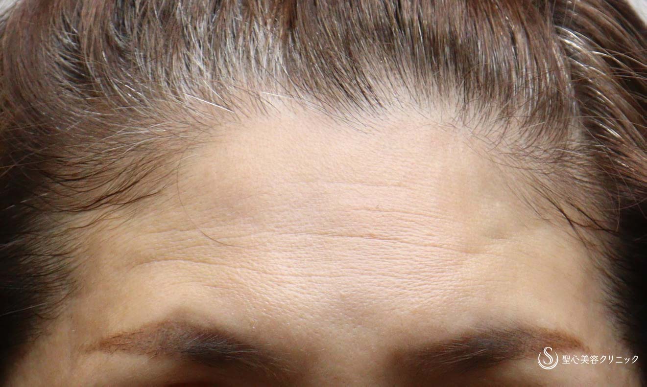 【50代女性・額のシワ】プレミアムPRP皮膚再生療法（追加2か月後） Before 