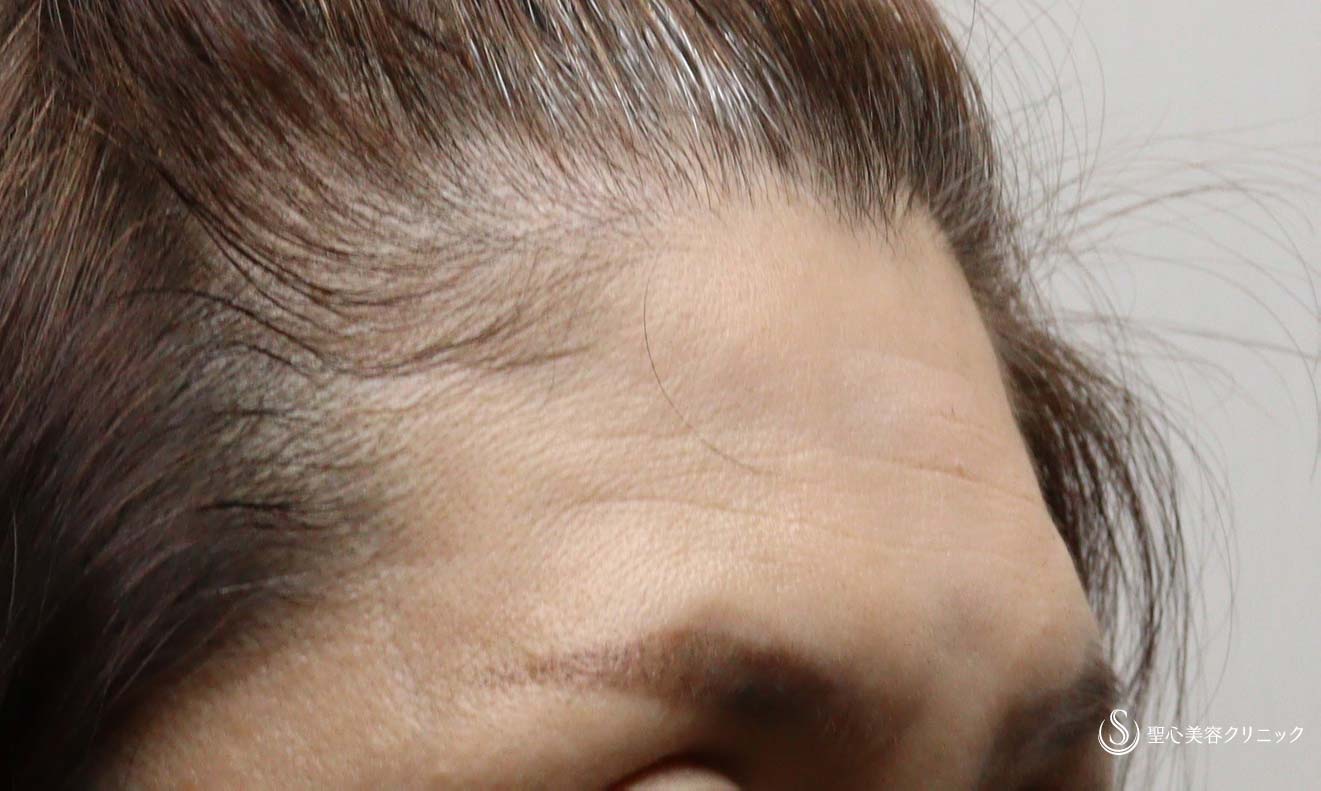 【50代女性・額のシワ】プレミアムPRP皮膚再生療法（追加2か月後） Before 
