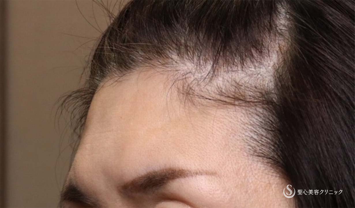 【50代女性・額のシワ】プレミアムPRP皮膚再生療法（追加2か月後） After 