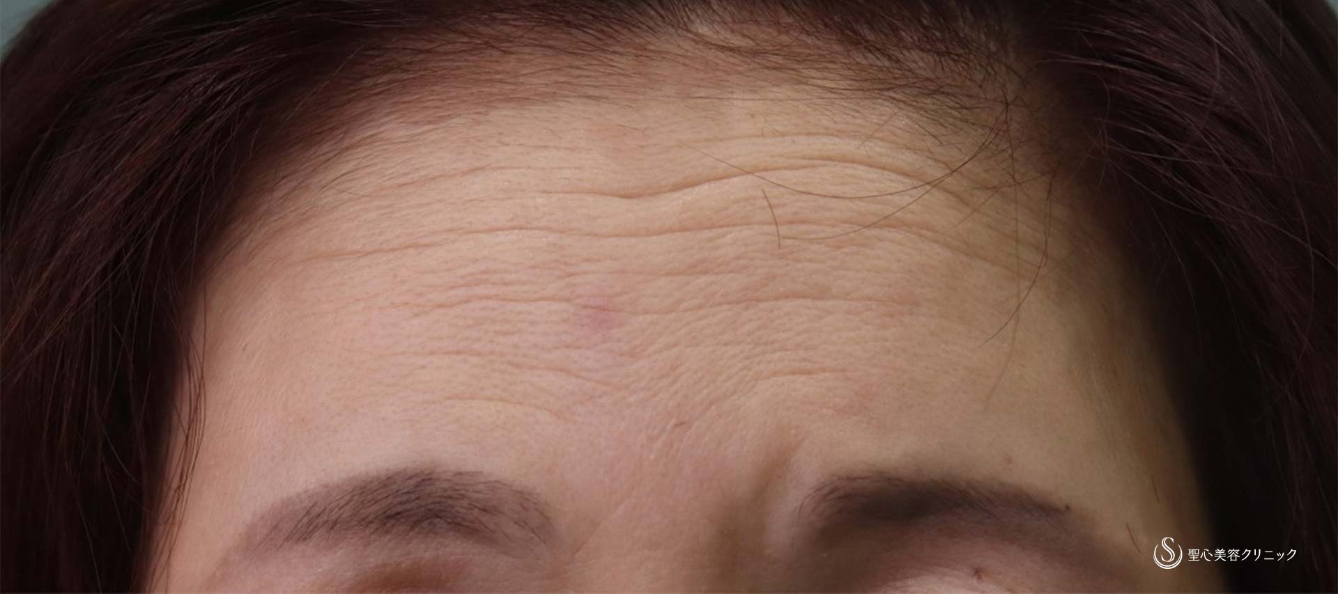 【50代女性・額のしわ】プレミアムPRP皮膚再生療法（術後7か月後） Before 