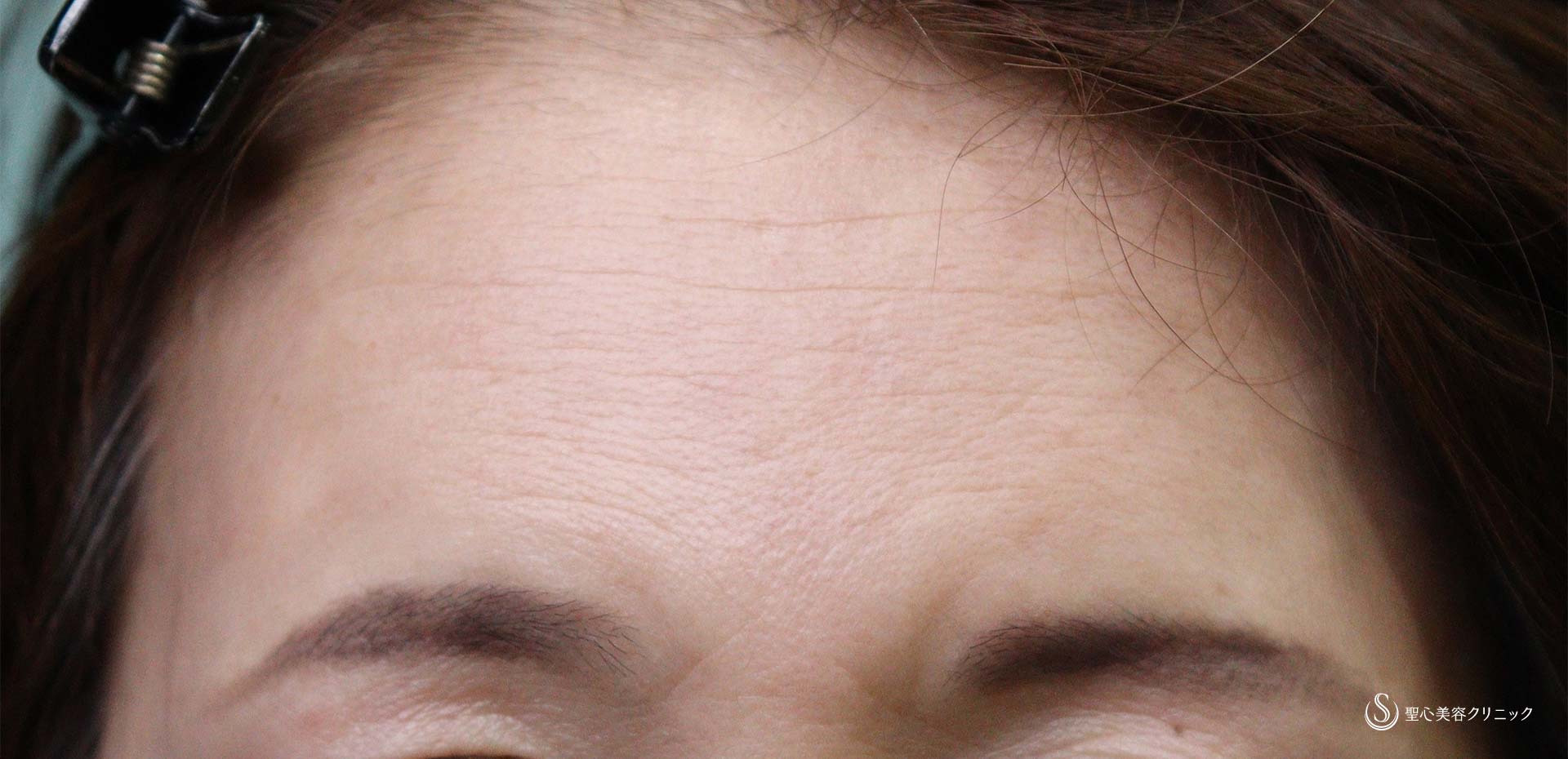 【50代女性・額のしわ】プレミアムPRP皮膚再生療法（術後7か月後） After 