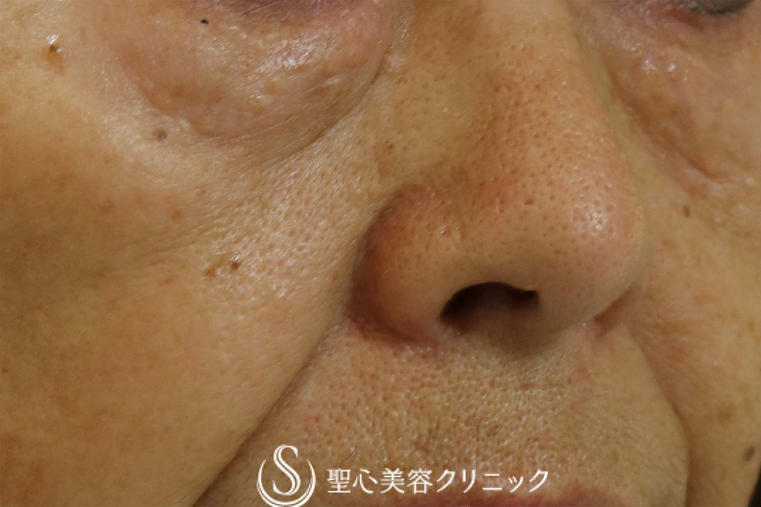 【60代女性・目の下のくぼみ】プレミアムPRP皮膚再生療法（2年後） Before 