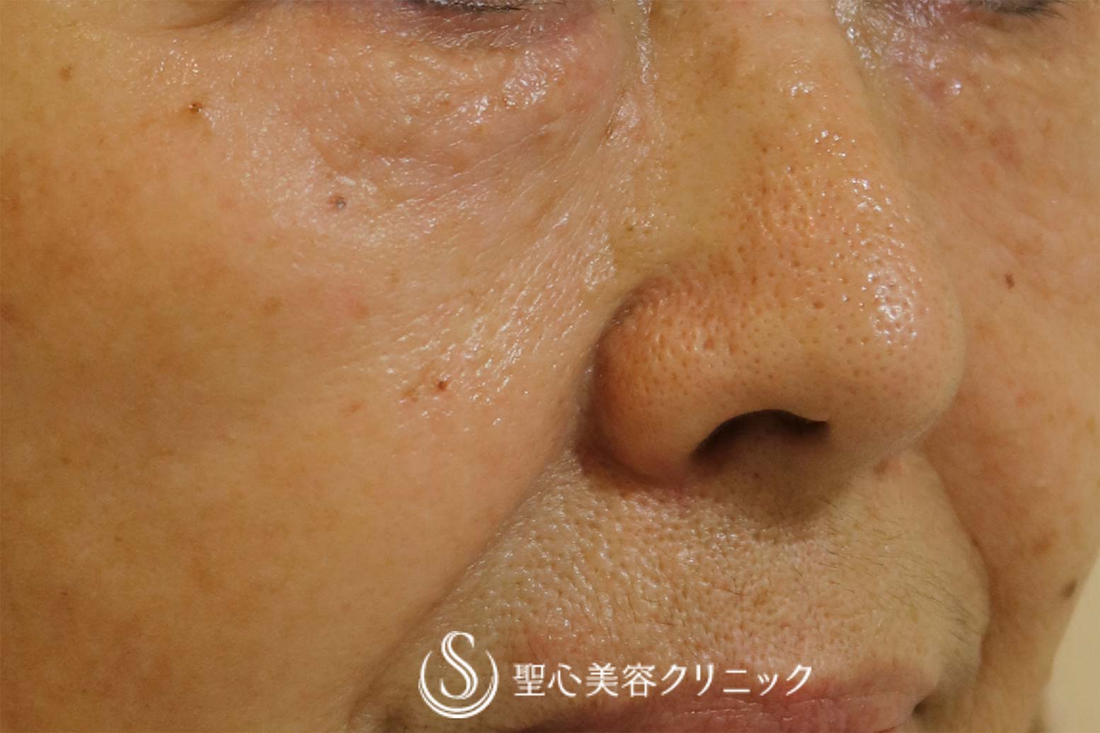 【60代女性・目の下のくぼみ】プレミアムPRP皮膚再生療法（2年後） After 